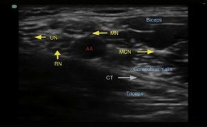 Ultrasound image of the brachial plexus at the axillary level. UN=ulnar nerve, RN=radial nerve, MN=median nerve, MCN=musculocutaneous nerve, AA=axillary artery, CT=conjoined tendon.