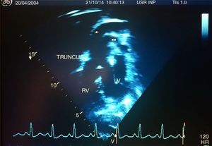 Transthoracic echocardiogram: shows the Common Trunk (TRUNCUS), Aorta (*), Pulmonary Artery (**), Right Ventricle (RV), and Left Ventricle (LV).