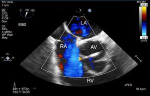 Mid esophageal RV inflow-outflow tract view. CFD shows flow just below the aortic valve to the right atrium.