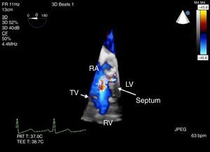 3-D CFD across the defect seen from Fig. 1, ME four chamber view. Flow is seen above the level of the tricuspid valve (TV) with a defect in the septum.