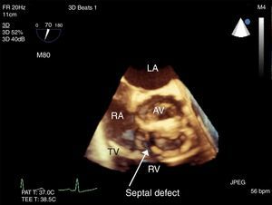 3-D image showing the septal defect above the tricuspid valve seen from Fig. 2, ME RV inflow-outflow tract view.