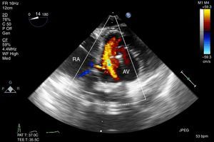 Deep trans-gastric view showing aortic valve and right atrium. CFD showing flow though the septal defect.