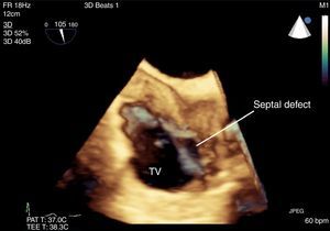 3-D ME bicaval view. Septal defect is visualized just above the tricuspid valve.