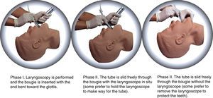 Passage of the bougie and the tracheal tube.