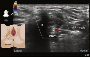 Perineal ultrasound in colour Doppler mode showing the ischial tuberosity (IT), superficial transverse perineal muscle (sTP) and the pudendal neurovascular bundle (PNBV).