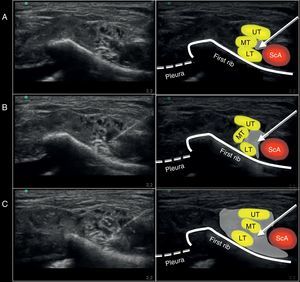 Ultrasound image captured during the administration of the supraclavicular block using a medial approach on the anatomic specimen. (A) Position of the needle at the injection site. (B) Ultrasound image during the 10ml injection. (C) Ultrasound image after completing the 20ml injection. ScA, subclavian artery; UT, upper trunk; MT, middle trunk; LT, lower trunk. The arrow points toward the position of the neurostimulation needle. The gray shade shows the distribution of the volume injected at the injection site evaluated with ultrasound.