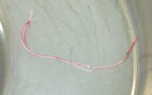 Epidural catheter segment that broke, was completely removed.