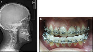 Female patient, 18 years and 11 months old, with severe midface hypoplasia. a. Cephalometric radiograph. b. Patient's dental occlusion.