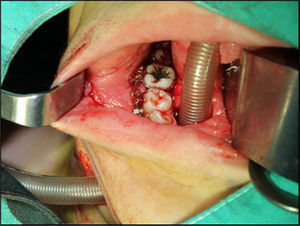Submental intubation. The endotracheal tube can be seen externally in the oral cavity through a tunnel in the submental region.