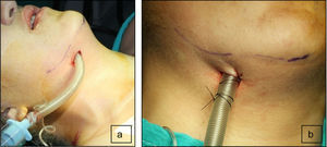 Submental intubation. a. Endotracheal tube externally positioned in a submental approach. b. Endotracheal tube suture fixation to the chin skin to avoid displacement during surgery.