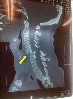 Sagittal reconstruction of the TC of the cervical spine of Case 1. Dislocation C5–6 (arrow).
