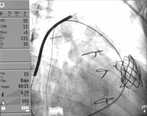 Radioscopic image of the Melody® pulmonary implant at the pulmonary level. Source: Authors.