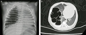 (a and b) Pre-surgical chest X-ray and CT case no. 1.