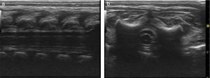 (a and b) Epidural space in a neonate with US-guided spreading of local anesthesia at the thoracic level. (a) Sagittal section. (b) Coronal section. High frequency transducer. Case no. 1.