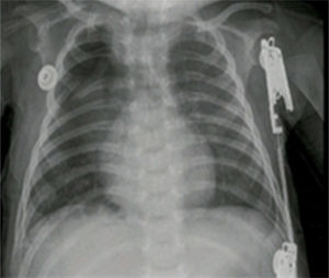 Control chest X-ray during the postoperative period. Case no. 1.
