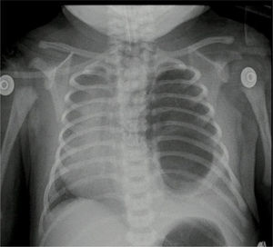 Pre-surgical chest X-ray. Case no. 2.