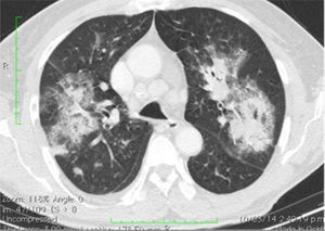 Plain chest CT: consolidation areas in lower, upper and middle lobes with ground glass pattern. No lymph node disease, cardiomegaly or pleural or pericardial effusion.