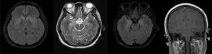 Brain MRI. Scant limbic enhancement.
