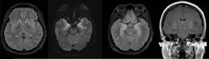 Brain MRI. More noticeable limbic enhancement.