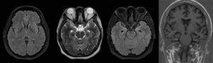 Brain MRI. Improved limbic enhancement.
