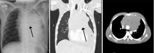 Diagnostic imaging. The arrows point to the mediastinal mass. Source: authors.