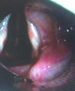 Subglottic stenosis following dilatation. Source: Authors.