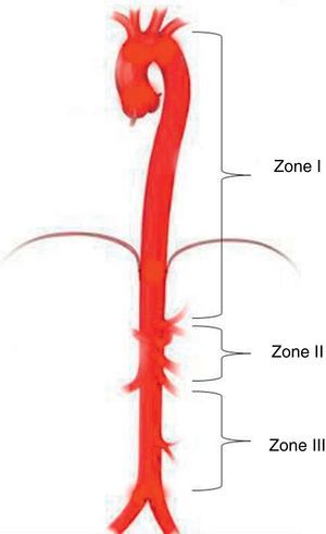 Aortic occlusion zones. Zone III starts at the bifurcation of the iliac arteries and extends to the most inferior renal artery. Zone II extends from the most inferior renal artery to the celiac trunk. Zone I extends from the left subclavian artery to the celiac trunk.