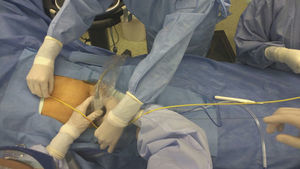 REBOA measurement using external anatomical landmarks; in this case, for insertion in Zone III.