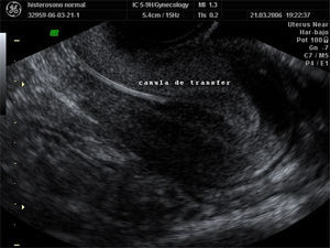 Ecografía que muestra la presencia de la cánula de transferencia aproximándose al tercio medio endometrial.