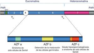 Diagrama del cromosoma Y. Incluye la representación de las regiones Pseudoautosomal Region (PAR) en los brazos corto (Yp) y largo (Yq) del cromosoma, la región Sex-determining Region Y (SRY) y una ampliación con las distintas regiones Azoopermic Factor (AZF). Bajo cada región AZF se indica el fenotipo histológico testicular característico clásico para los casos de deleción completa de dichas regiones, si bien la deleción parcial de las regiones AZFa y AZFb puede ocasionar hipoespermatogénesis.