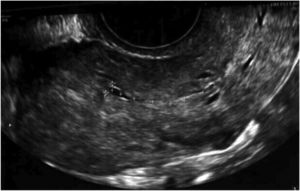 Supuesta zona de línea endometrial en ecografía transvaginal.