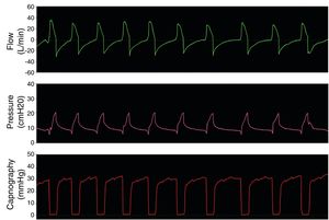 Simulation of Model 3 in a healthy patient with spontaneous breathing.