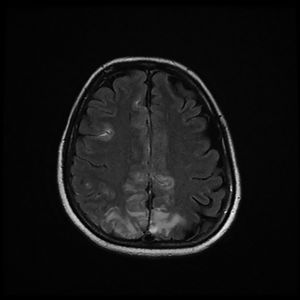 Magnetic resonance imaging (T2-weighted and FLAIR images): Axial slices showing hyperintense areas with bilateral cortical and subcortical white matter involvement, more extensive in the right hemisphere. Involvement is seen in the parasagittal region and bilateral parietal convexity, and in the bilateral frontal parasagittal region. The image is suggestive of PRES.