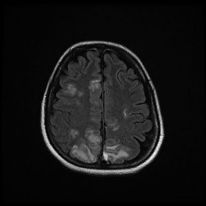 Magnetic resonance imaging (T2-weighted and FLAIR images): Axial slices showing hyperintense areas with bilateral cortical and subcortical white matter involvement, more extensive in the right hemisphere. Involvement is seen in the parasagittal region and bilateral parietal convexity, and in the bilateral frontal parasagittal region. The image is suggestive of PRES.