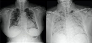 On the left, posteroanterior chest radiograph on admission, showing bilateral peripheral consolidations in upper, middle and lower fields, with no pleural effusion - findings suggestive of infection by COVID-19. On the right, anteroposterior chest X-ray in decubitus 3 days after admission, prior to orotracheal intubation, showing radiological evolution of the disease.