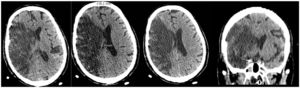 Contrast-enhanced brain CT scan of patient 1. Extensive area of right fronto-temporoparietal corticosubcortical hypodensity extending to the ipsilateral basal ganglia associated with subacute infarction in the territory of the right middle cerebral artery that causes a mass effect with obliteration of cortical sulci in right convexity, narrowing of the ipsilateral lateral ventricle and midline shift 6.6 mm to the left. Hyperdense linear images are observed In the region of some right cortical sulci. Although these may correspond to impinging cortical areas, an associated cortical or subarachnoid microbleeding component cannot be ruled out.