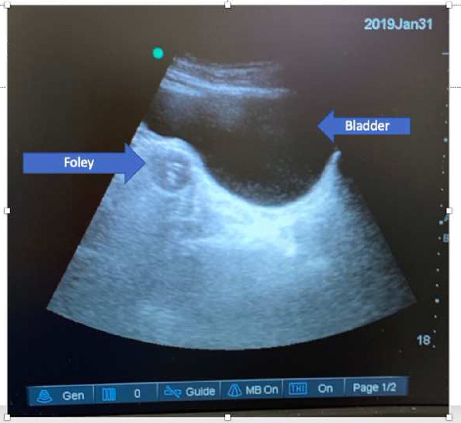 Extraperitoneal placement to a Foley catheter detected with POC ...