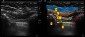 Ultrasound view of the PIFB blockade. 1. Pectoralis major muscle. 2. Infiltration of local anaesthetic. 3. Intercostal muscle. 4. Rib. 5. Pleura.