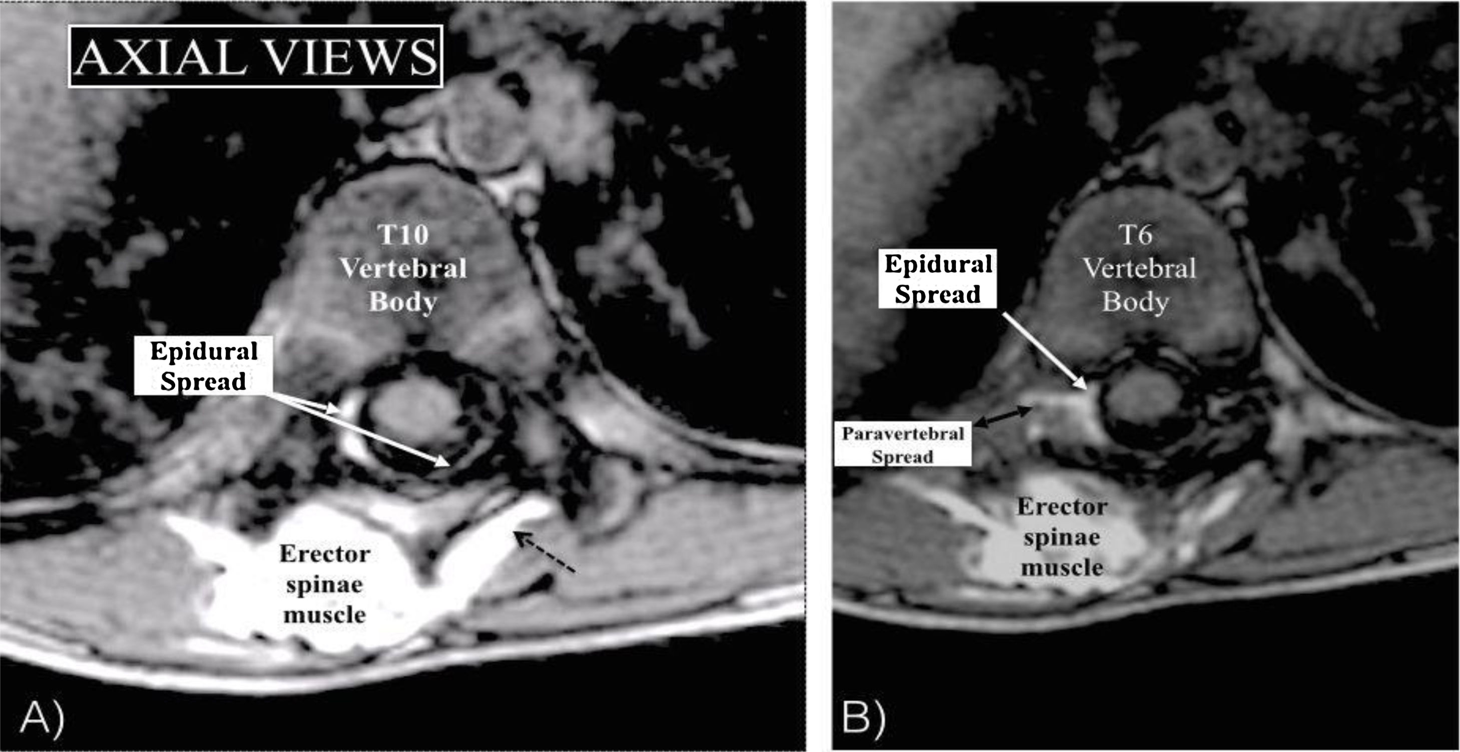 Espb Block Site of action of erector spinae plane block (ESPB) – A magnetic ...