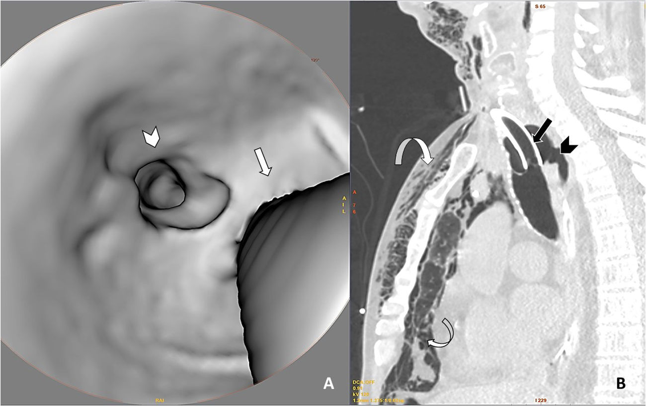 Iatrogenic tracheal rupture in a patient with acute respiratory ...