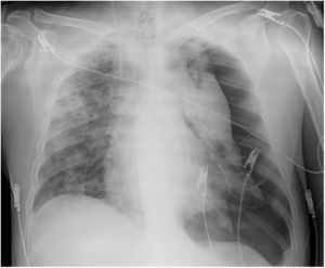 Chest X-ray (patient 5). Opacities in the right lung, massive left pneumothorax (prior to insertion of the drain), catheter in the right internal jugular vein.