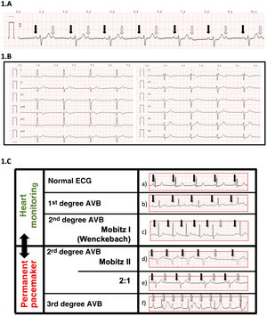 ECG showing a 2:1 AVB in lead DII A) (continuous arrow, conducting P wave; dotted arrow, non-conducting P wave); and in all bipolar leads. B) In most cases, this heart block is considered high risk for complete AVB and permanent pacemaker implantation is frequently indicated, particularly in the presence of a QRS with a bundle branch block pattern. In the event of a surgical emergency, the placement of a temporary pacemaker (electrocatheter) should be considered. Image C) shows lead DII of the ECG in different types of AVB. Pacemaker implantation prior to surgery is based on visual assessment. a) Normal ECG: all P waves conduct. PR<200 msg. b) 1st degree AVB: all P waves conduct. PR>200 msg. 2nd degree AVB: some P waves conduct. c) Mobitz I (Wenckebach): progressive lengthening of the PR interval until conduction block. d) Mobitz II: constant PR. Non-conducted P waves. e) Type 2:1: intermittent non-conducted P waves (1 conducts and another does not). Typically with HR of 40–50x’. f) 3rd degreed AVB (complete): non-conducted P wave. Usually with extreme bradycardia (30–35x’) and wide QRS. (Solid arrow, P-wave conducts; dotted arrow, P-wave does not conduct).