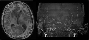 Contrast-enhanced brain MRI showing no contrast-enhancing lesions; however, angiography showed diminished cerebral blood flow and the presence of extracranial flow, compatible con cerebral circulatory arrest.