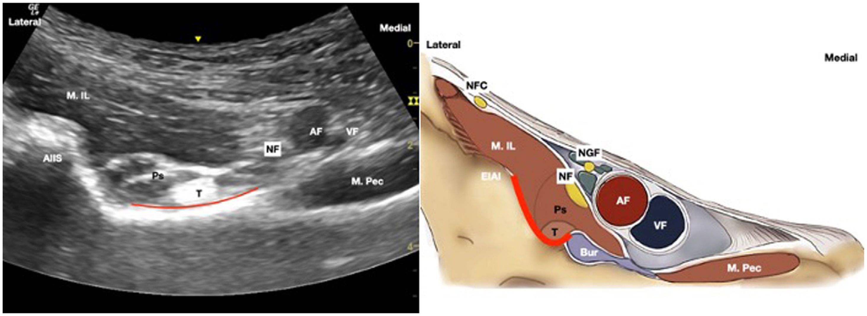 New Ultrasound Guided Capsular Blocks For Hip Surgery A Narrative