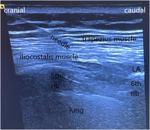 Description of the parascapular sub-iliocostalis plane block performed in patient 3. With the patient in a lateral position, with both arms along the body, a high-frequency linear ultrasound probe was placed with a parasagittal orientation, immediately adjacent to the medial scapular border at the level of the edge of the sixth rib level. Identification of the lateral border of the iliocostalis muscle and performance of the parascapular sub-iliocostalis plane block. The tendinous insertion of the ILCM at the rib is in the superolateral direction (it should not be confounded with the insertion of the levatore costarum muscles whose insertion is in the inferior-lateral direction). The rhomboid major or minor muscle and the posterior superior serratus muscles are observed between the trapezius muscle and the iliocostalis msucles at upper levels. Abbreviations: LA, local anesthetic spreading.