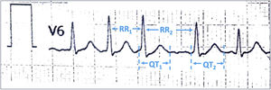 Example of QT interval measurement in patients with atrial fibrillation.