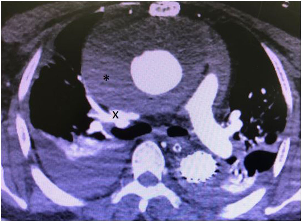 Superior vena cava syndrome in the postoperative setting of a type A ...