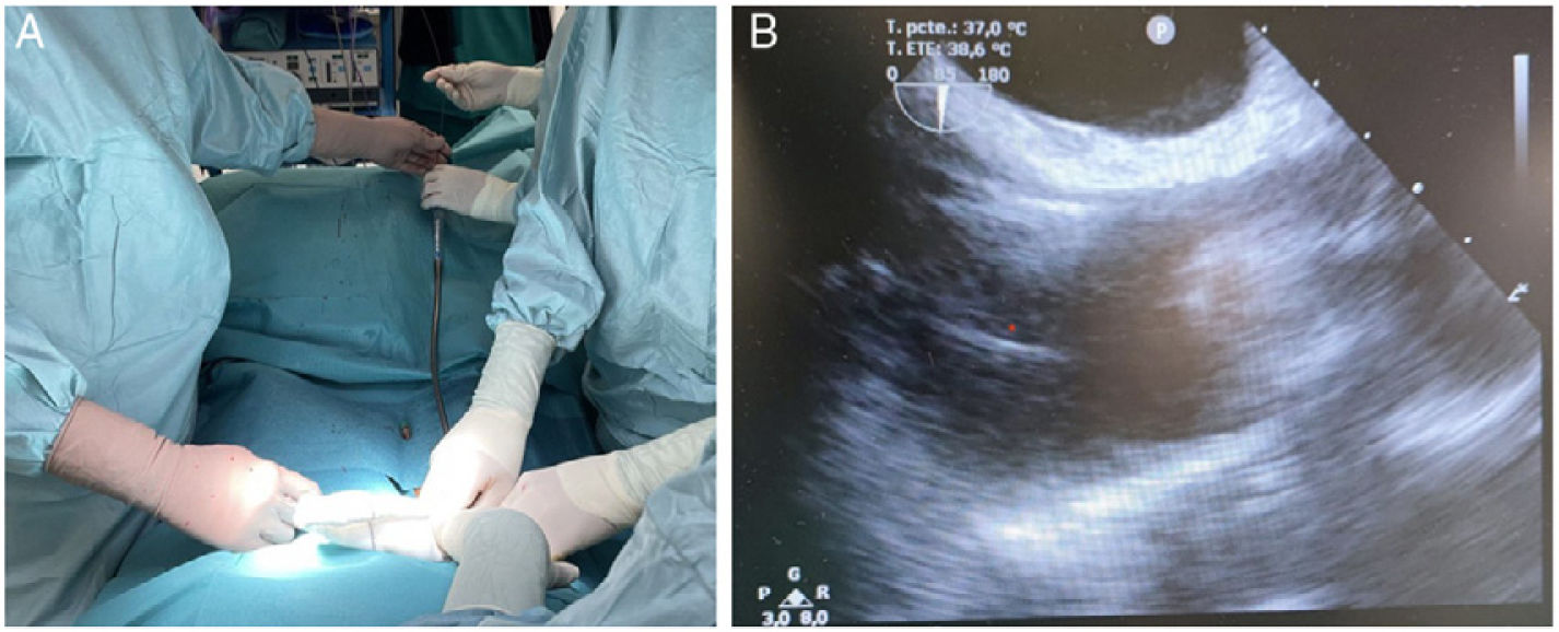 Role of VV ECMO tracheal surgery and carinal resection: Two case ...