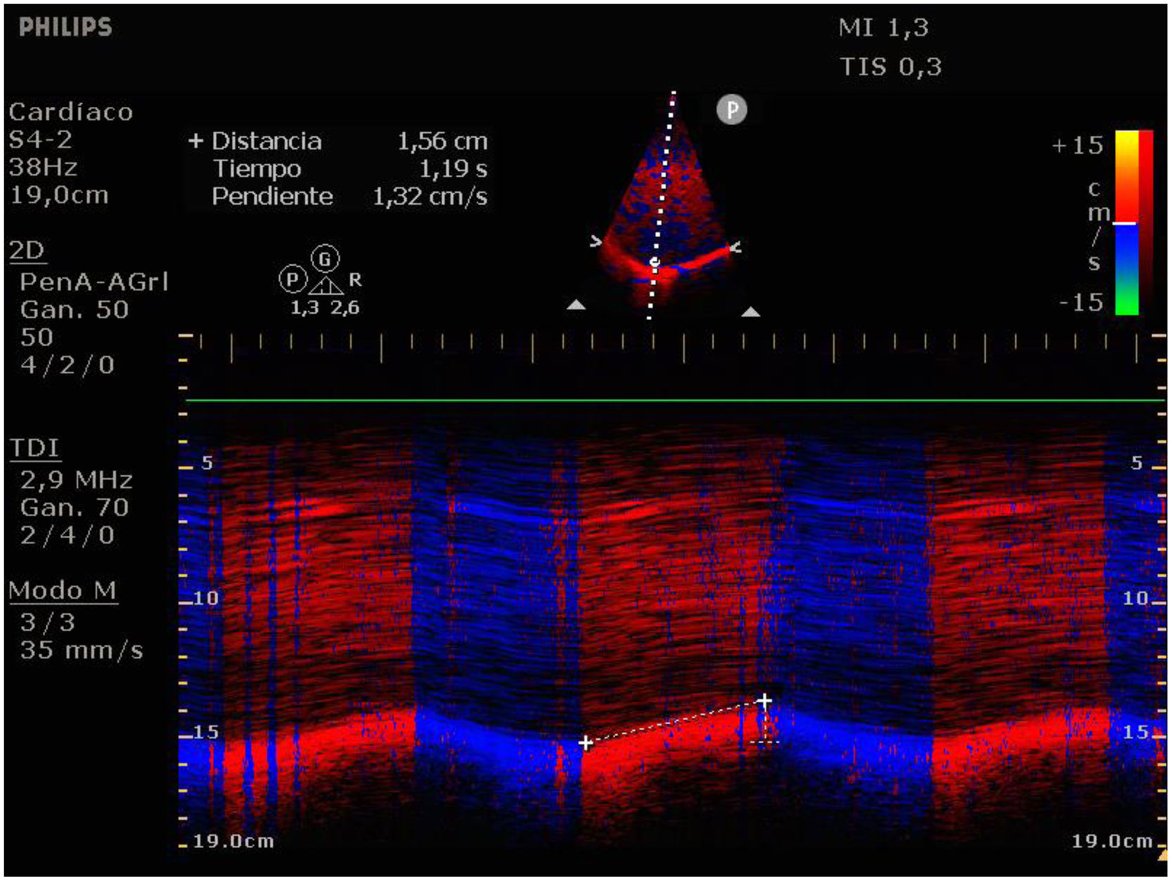 Diaphragmatic excursion with Color M-mode tissue Doppler imaging ...
