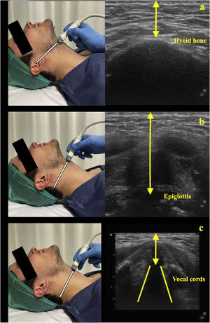 Ultrasound measurements of the skin-to-hyoid bone (a), skin-to-epiglottis (b) and skin-to-vocal cords (c).